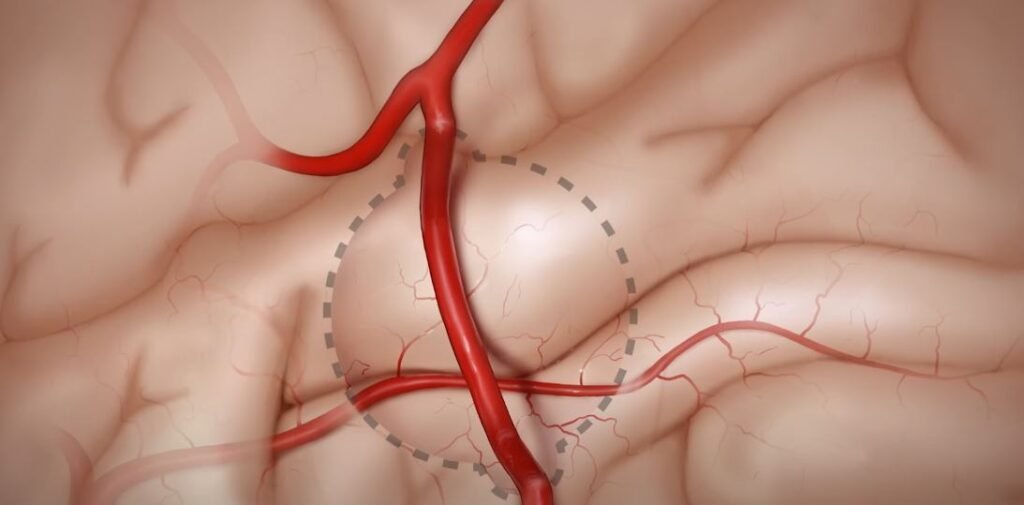 moyamoya disease