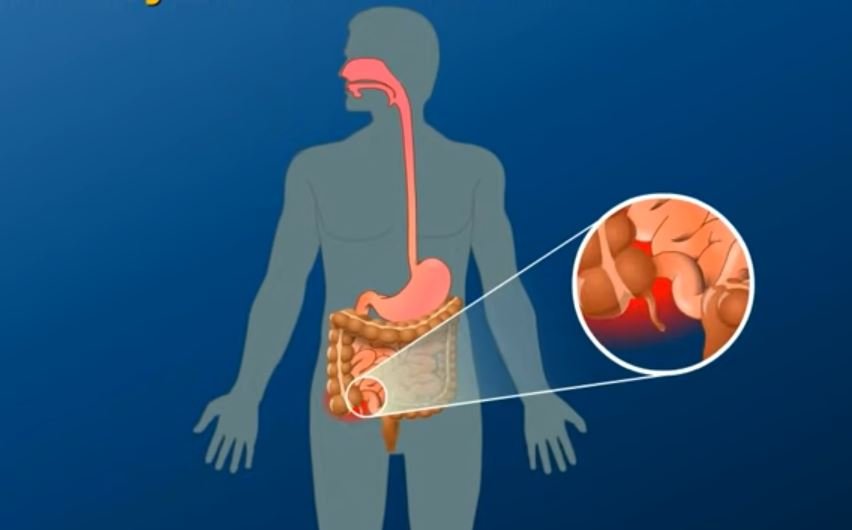 Crohn's Disease