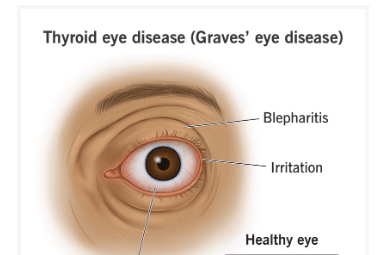 Thyroid Eye Disease