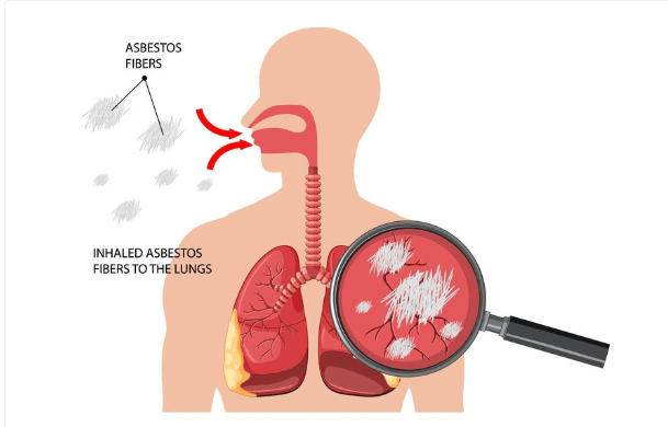 Whipple Disease